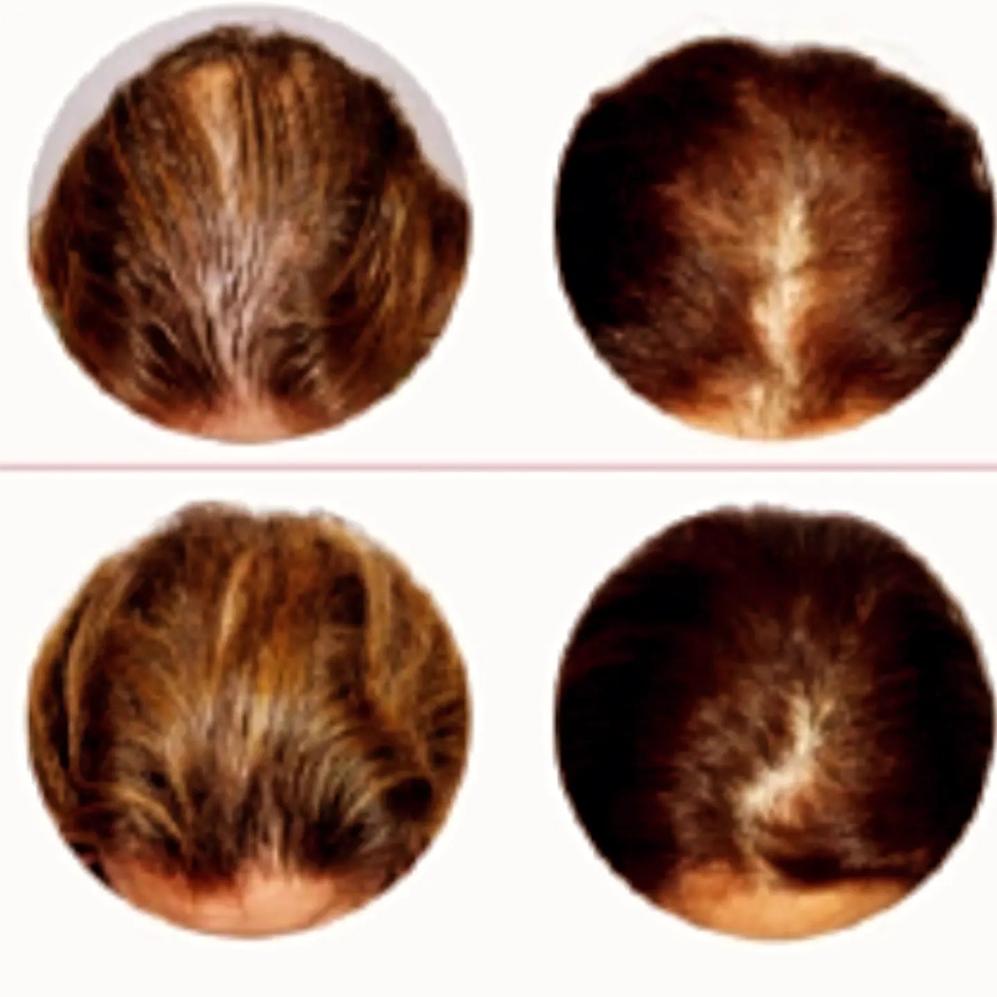 Capilla Longa is a potent herbal extract known for promoting hair growth by stimulating hair follicles and increasing scalp circulation. Clinical studies show it helps reduce hair thinning, improve hair density, and enhance overall scalp health for thicker, fuller hair.
