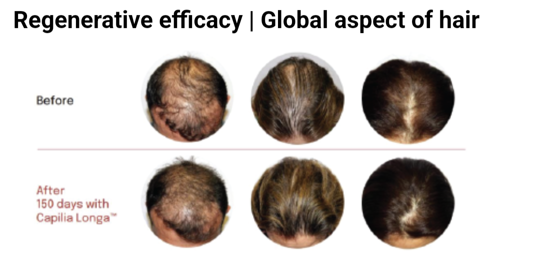 Capilla Longa is an effective plant extract that supports hair regrowth by stimulating dormant follicles and improving scalp circulation. Clinical studies highlight its ability to reduce hair shedding, boost density, and promote thicker, healthier hair growth.