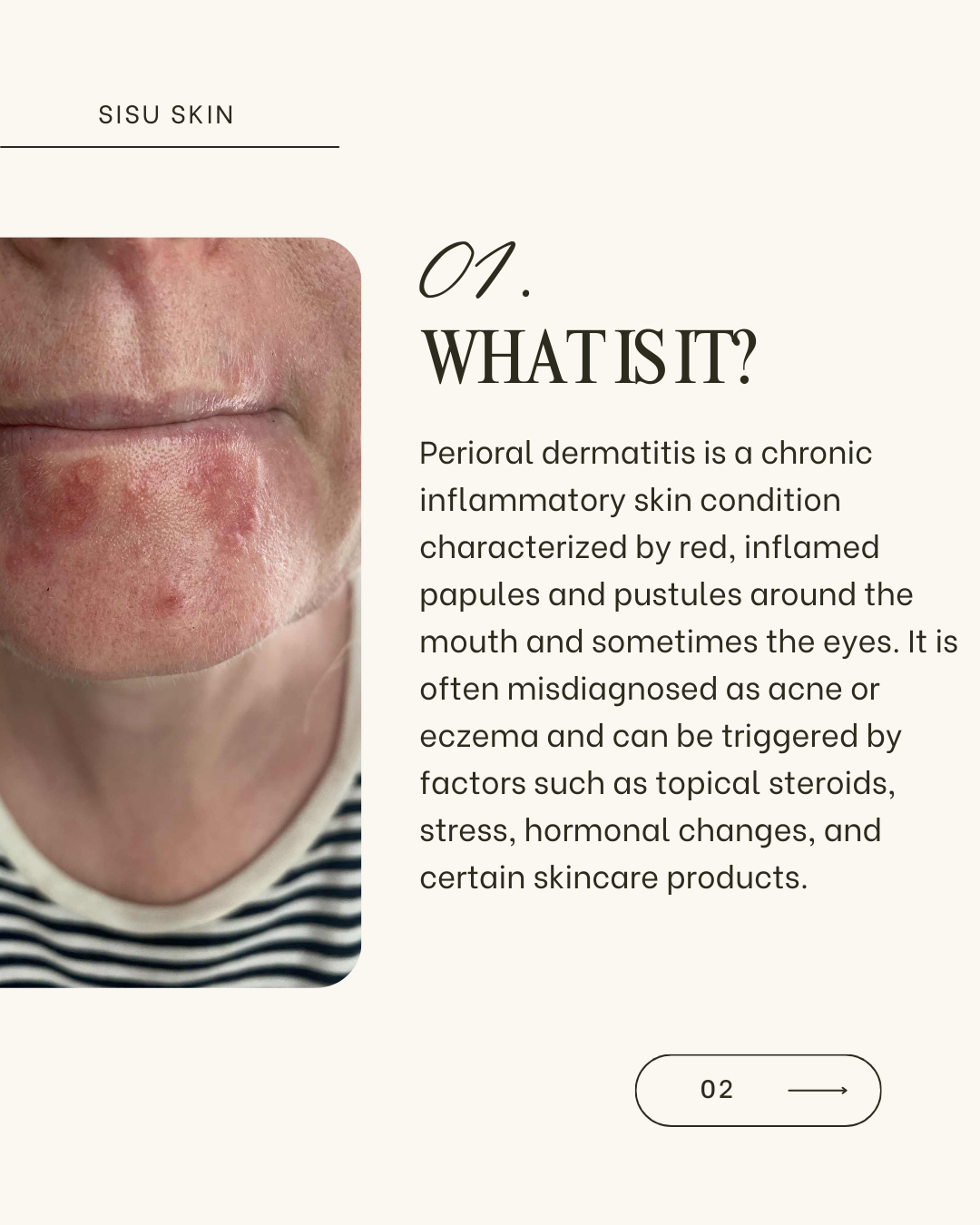 This carefully formulated moisturizer is ideal for calming and improving perioral dermatitis while remaining safe for fungal acne, regular acne, and sensitive skin. Plant-based squalane deeply hydrates and restores the skin barrier, preventing dryness and irritation that can trigger flare-ups. Bakuchiol gently supports skin renewal and evens tone without the harsh effects of retinol, while bisabolol reduces redness and inflammation, helping to soothe the characteristic bumps and irritation of perioral derma