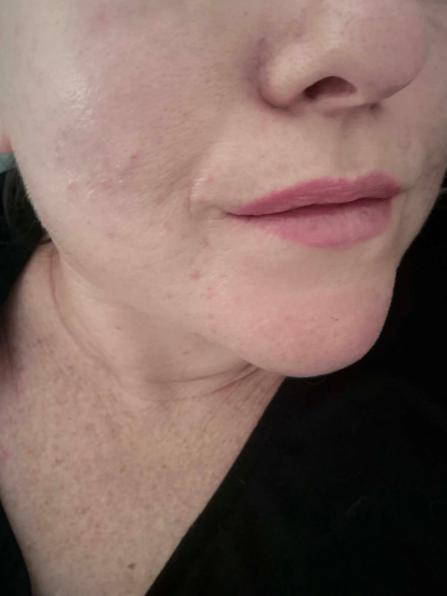 SOLAIS UNIVERSAL TREATMENT- FUNGAL ACNE & PERIORAL DERMATITIS SAFE MOISTURISER