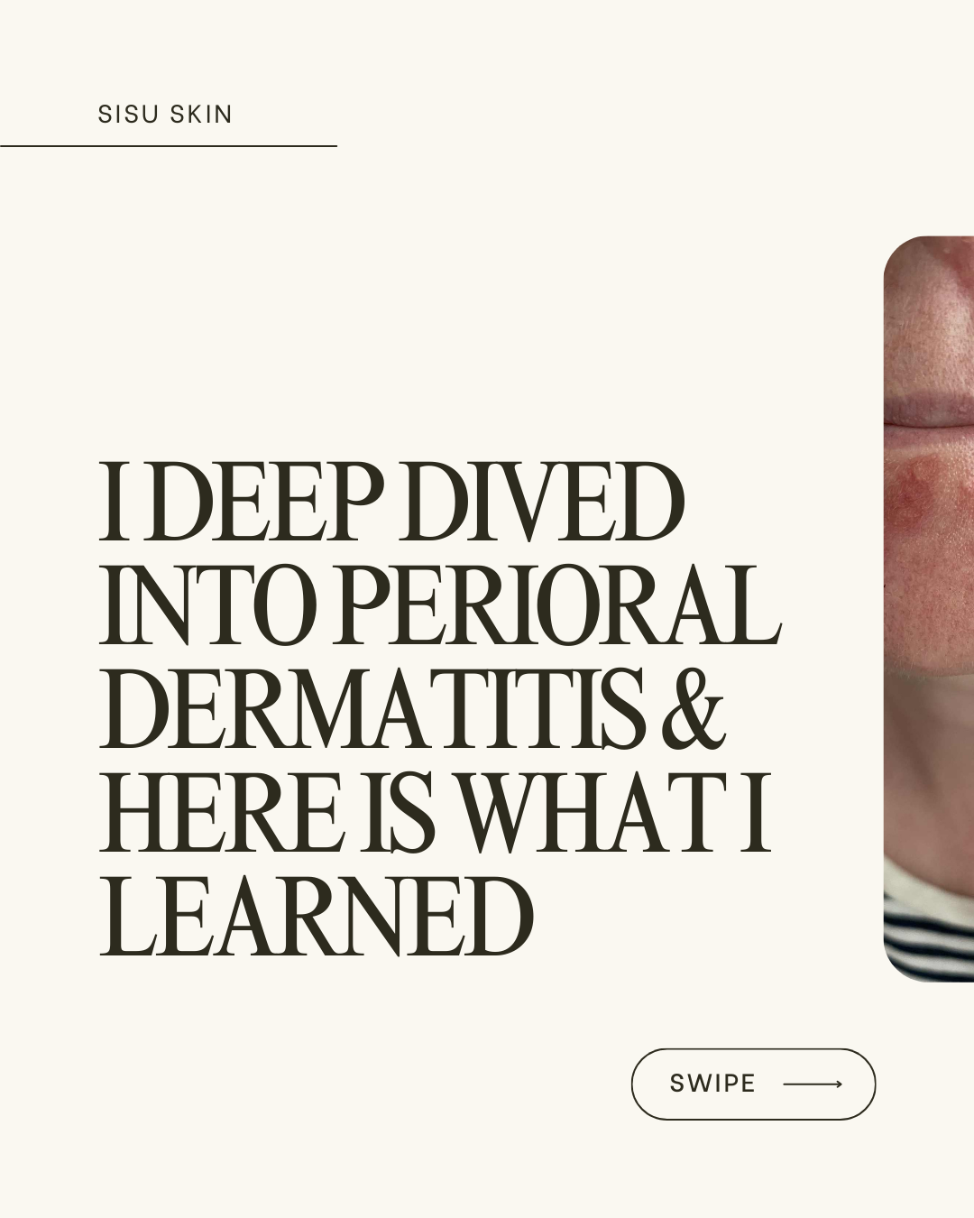 What makes this moisturizer safe for perioral dermatitis, sensitive skin, and acne-prone skin? How do plant-based squalane, bakuchiol, and bisabolol work to reduce redness, irritation, and inflammation? Can a lightweight, non-comedogenic formula restore the skin barrier, deeply hydrate, and support a healthier, more resilient complexion over time?