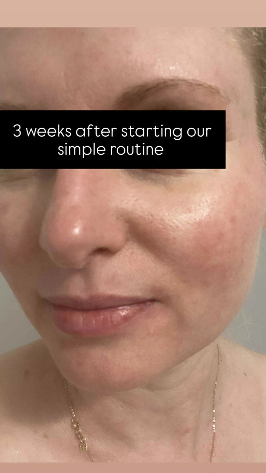 This ultra-soothing routine targets perioral dermatitis with calming, barrier-reinforcing, and redness-reducing ingredients. Lightweight oils like plant-derived squalane, regenerative bakuchiol, and anti-inflammatory bisabolol help strengthen the skin’s defenses, diminish irritation, and promote skin recovery. Pairing this with gentle, fragrance-free cleansing and minimal active use supports a balanced, resilient complexion and noticeable improvement in flare-ups over time.