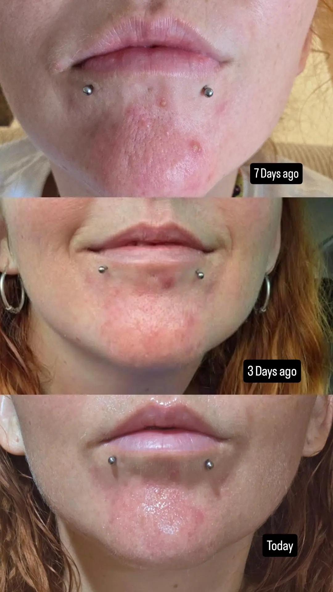 Before and after of a woman with pimples acne redness and inflammation showing a significant improvement in these conditions using a serum with copper and niacinamide