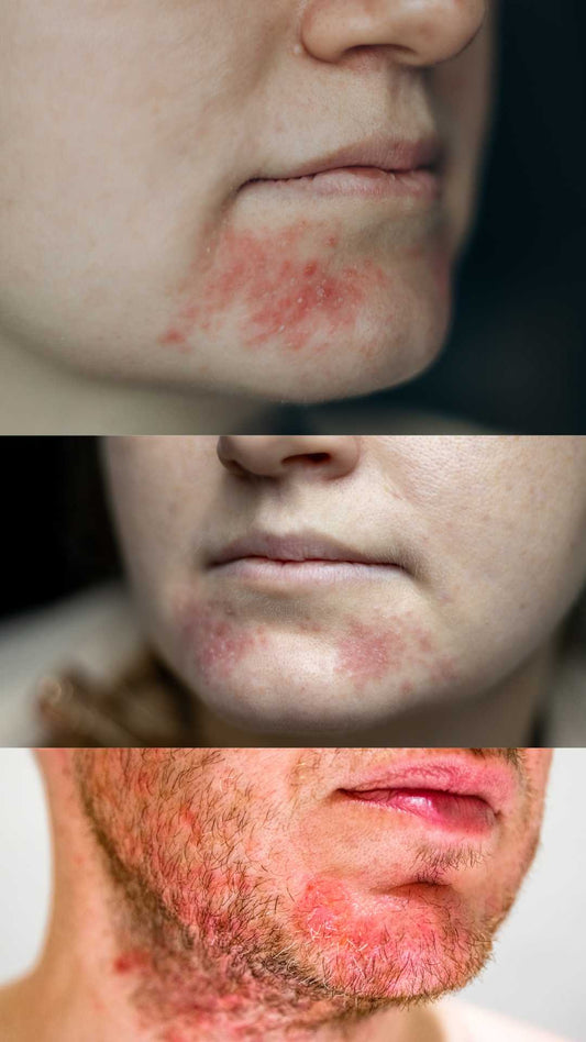 Perioral Dermatitis and the mystery that is managing it