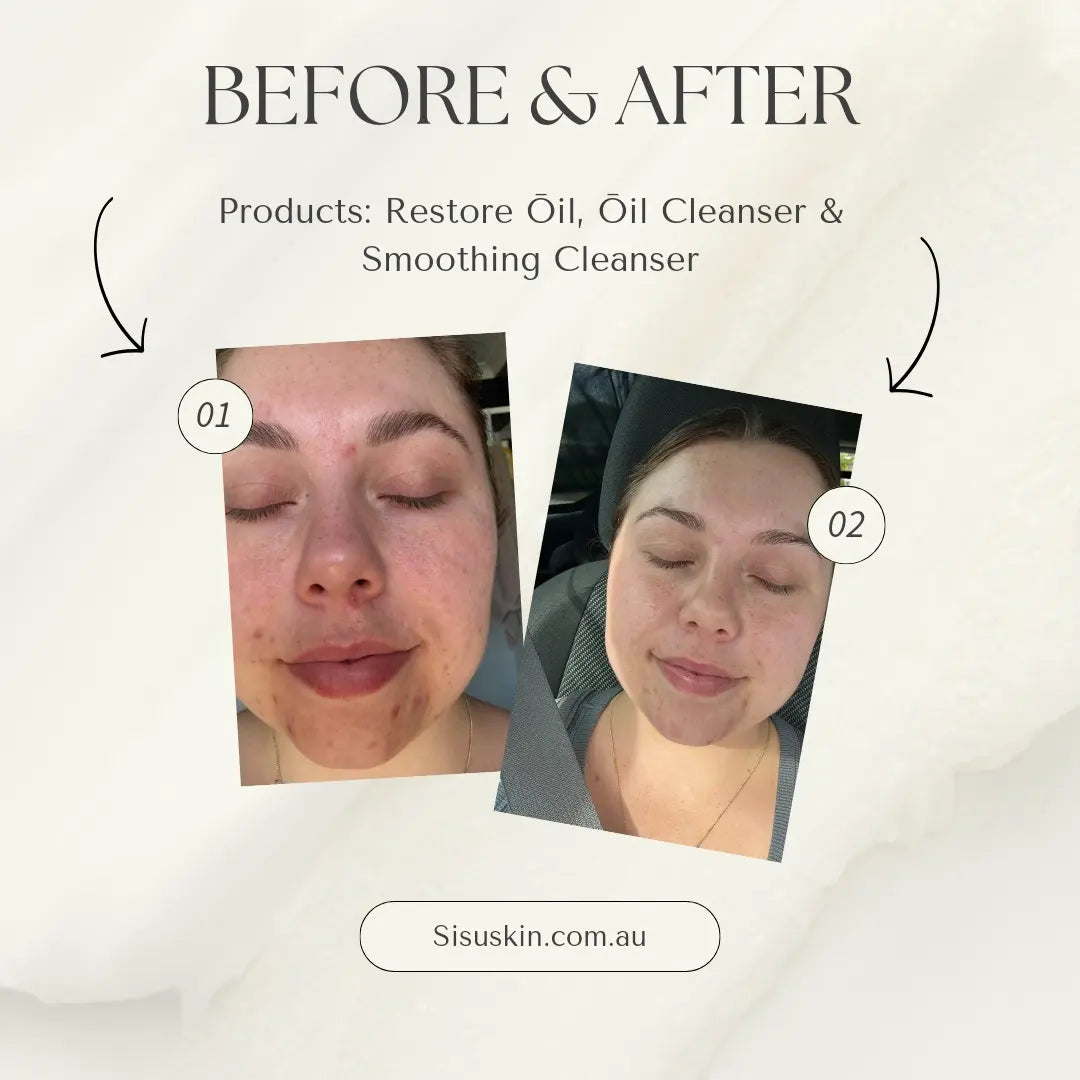 bedore and after skincare results healing skin reducing redness ceramides barrier repair and supporting skin health. helps with boosting skin hydration with hyalauronic acid